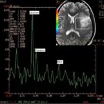 Magnetic resonance (MR) spectroscopy
