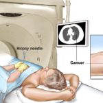 CT USG guided RFA and Biopsy93