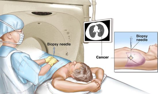 CT USG guided RFA and Biopsy93