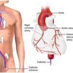 coronary-angiography-angiogram3