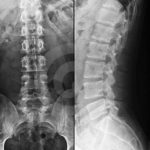 digital x ray spine